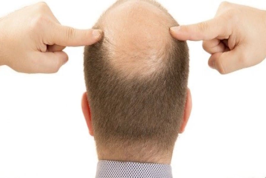 تساقط الشعر عند الرجال ... اسباب وعلاج وكيفية الوقاية
