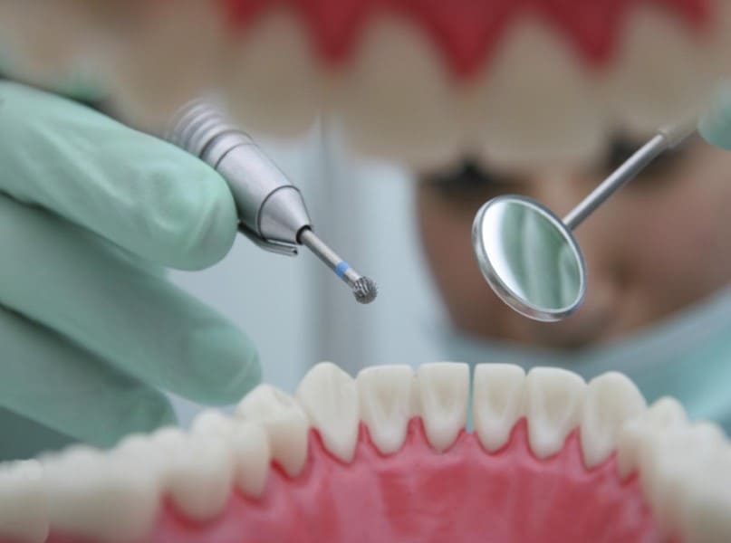 علاج تسوس الاسنان بدون طبيب في المنزل