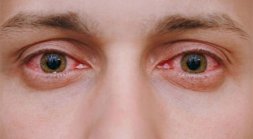 أفضل قطرات للعين للأشخاص الذين يعانون من احمرار العين