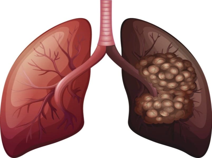 عوامل خطر الإصابة بسرطان الرئة لغير المدخنين هو ليس مجرد مرض يصيب المدخن