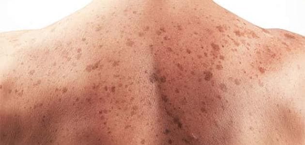 هل سرطان الجلد يسبب حكة