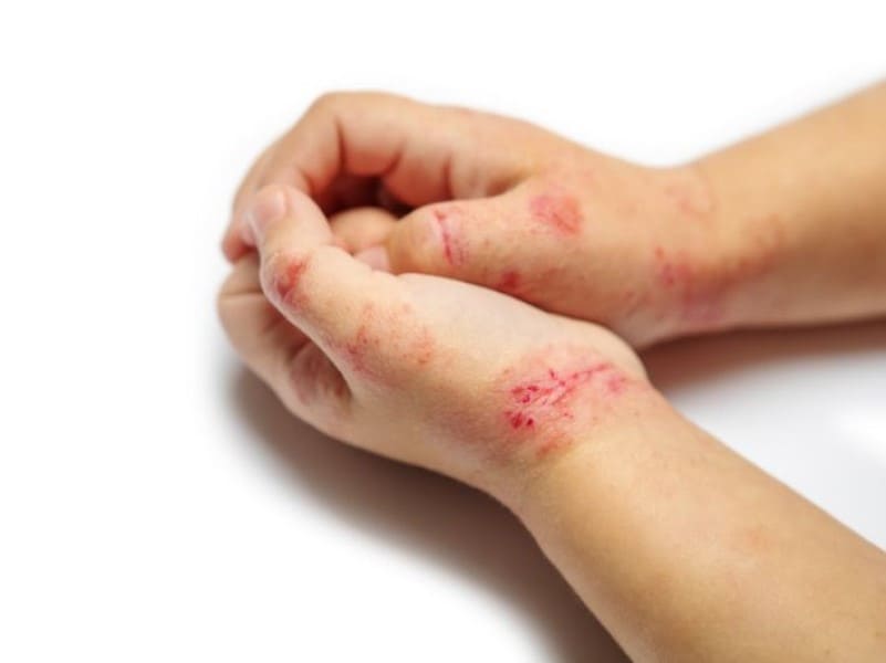 ماذا تفعل إذا كان طفلك يعاني من الأكزيما 3 خطوات لمنع تهيج الجلد