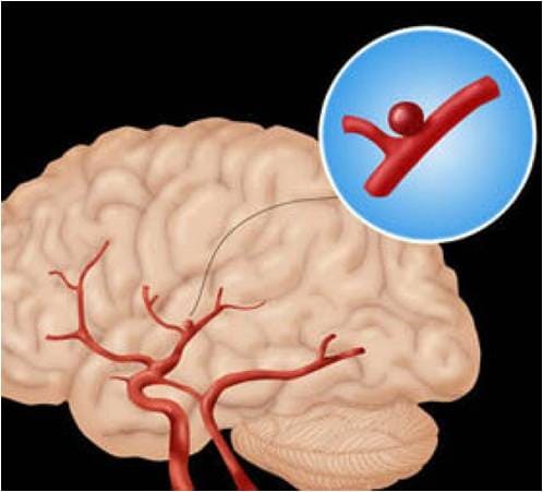 علاج التهاب الأوعية الدموية في الدماغ