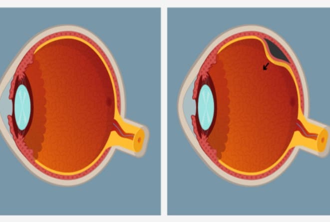 علاج انفصال شبكية العين