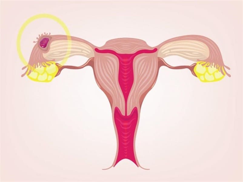 الحمل خارج الرحم هل يمكن ان يعيش ومتى يبدأ ظهور اعراضه؟