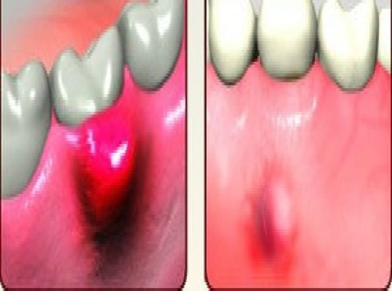 خراج الاسنان وخراج اللثه