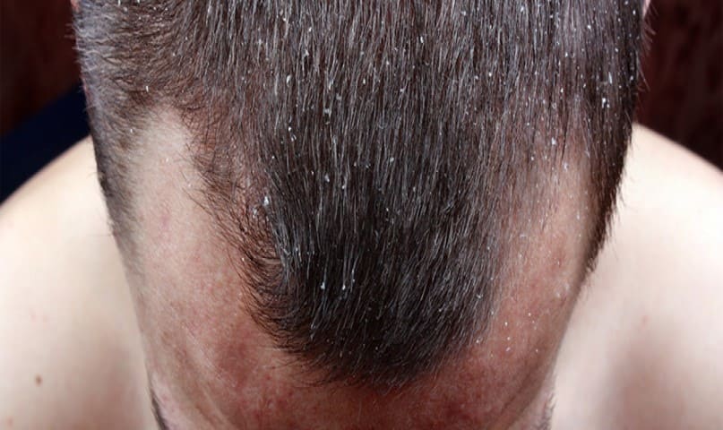 علاج قشرة الرأس 7 طرق علاج قشرة الشعر نهائياً
