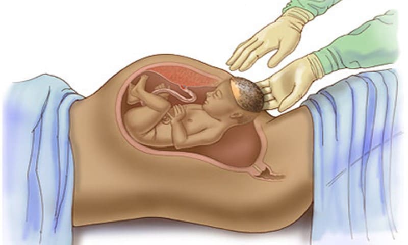 فوائد الولادة القيصرية و10 نصائح سلبيات وايجابيات الولادة القيصرية