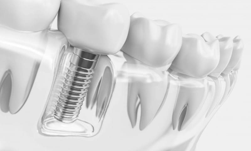 مدة زراعة الأسنان بعد الخلع .. هل يمكن زراعة الاسنان بعد الخلع مباشرة؟