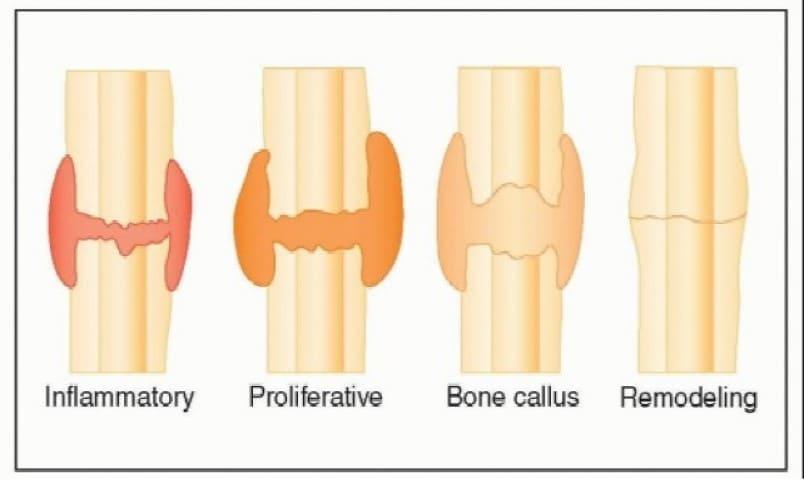 كسر العظام .. أنواع العظام المكسورة .. مراحل التئام العظام بالصور