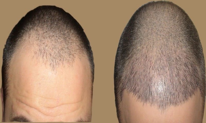 أضرار زراعة الشعر على المدى البعيد .. ما هي الاثار الجانبية لزراعة الشعر