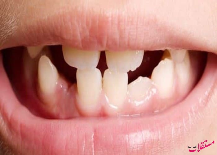 تفسير حلم الأسنان الأمامية متفرقة